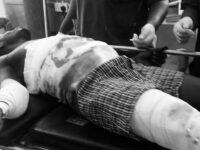 E/R:Vulcanizer Machine Explodes in Mankessim, Man Left Fighting for Life.