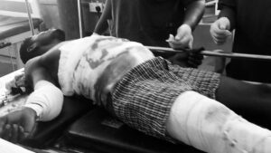Vulcanizer Machine Explodes in Mankessim, Man Left Fighting for Life.
