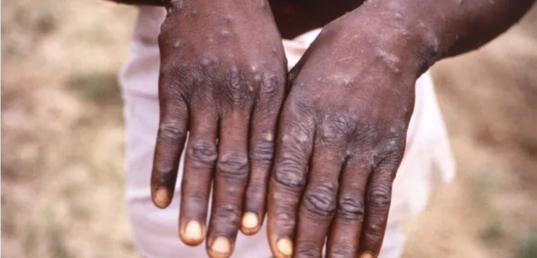GHS confirms 18 new Mpox cases, total now 346.