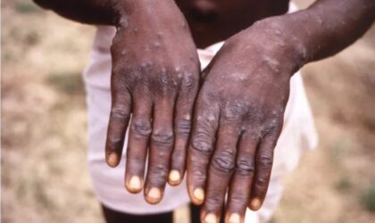 GHS confirms 18 new Mpox cases, total now 346.