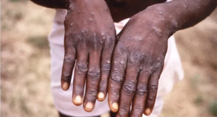 GHS confirms 18 new Mpox cases, total now 346.