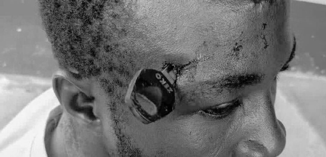 Man Rushed to Korle Bu After Motorcycle Key Lodged in Skull During Okada Fight at Jasikan  