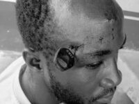 Man Rushed to Korle Bu After Motorcycle Key Lodged in Skull During Okada Fight at Jasikan  