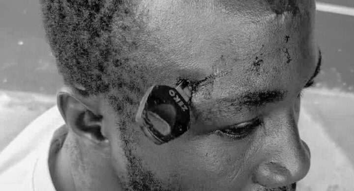 Man Rushed to Korle Bu After Motorcycle Key Lodged in Skull During Okada Fight at Jasikan  