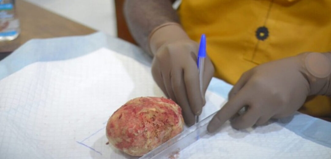 Kumasi Hospital Removes 880-Gram Bladder Stone In Rare Surgical Case