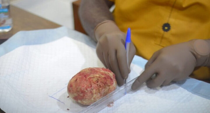 Kumasi Hospital Removes 880-Gram Bladder Stone In Rare Surgical Case